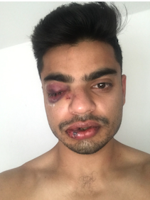 aditya injured